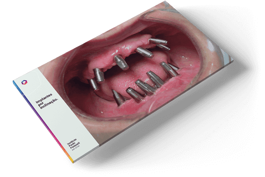 O que é o TCO: Antes do TCO - Implantes por inclinação no início dos anos 2000