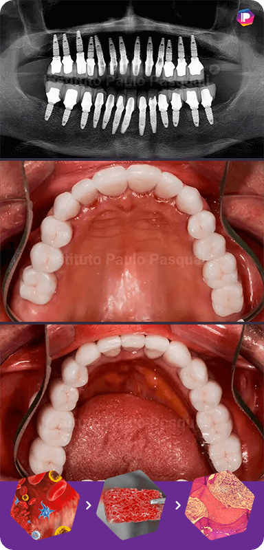 Enxertia e implantes com TCO - Transplante Celular Odontológico