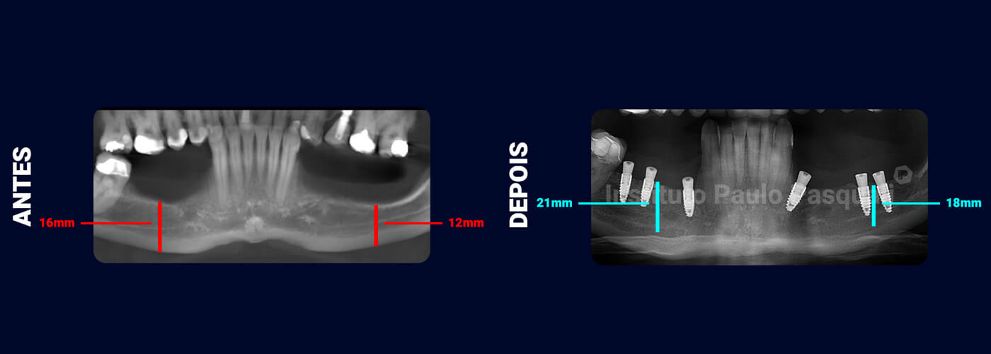 Mandíbula: Aumento vertical e horizontal sem biomaterial