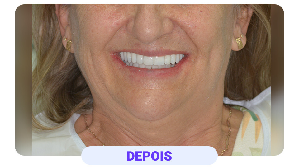 Perdeu o zigomático e voltou para prótese total e agora tem implantes individualizados - frontal