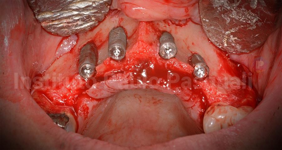 Implantes colocados na realização de enxerto em bloco e implante na mesma sessão, com apenas uma parede sem uso de osso autógeno ou centrifugação