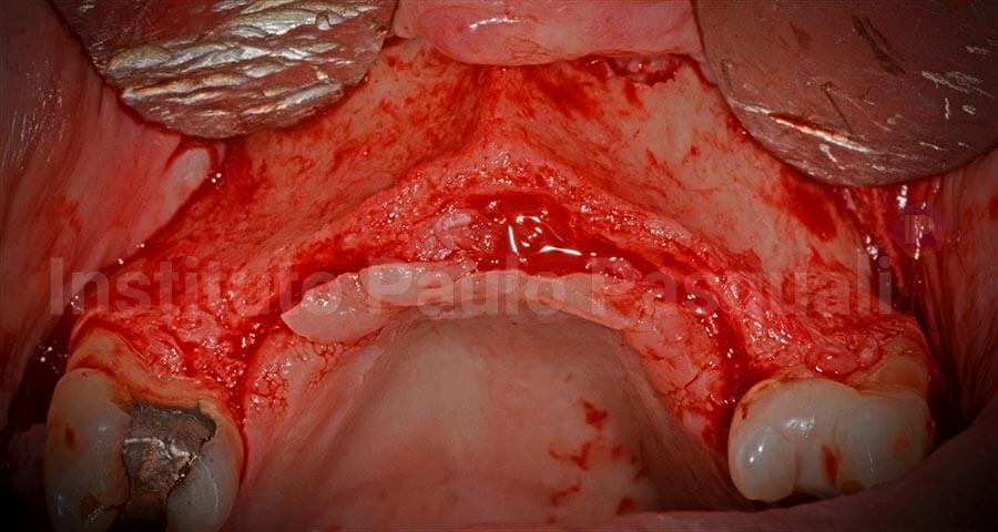 Início da realização de enxerto em bloco e implante na mesma sessão, com apenas uma parede sem uso de osso autógeno ou centrifugação