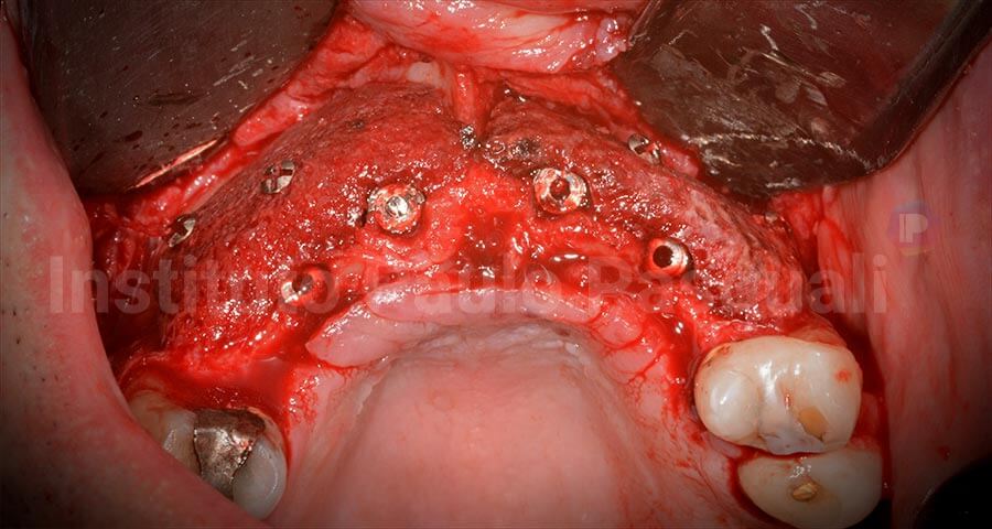 Uso do biomaterial na realização de enxerto em bloco e implante na mesma sessão, com apenas uma parede sem uso de osso autógeno ou centrifugação